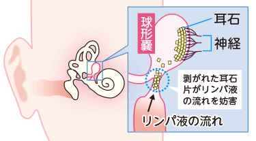  BPPV とともに生きるためのヒント